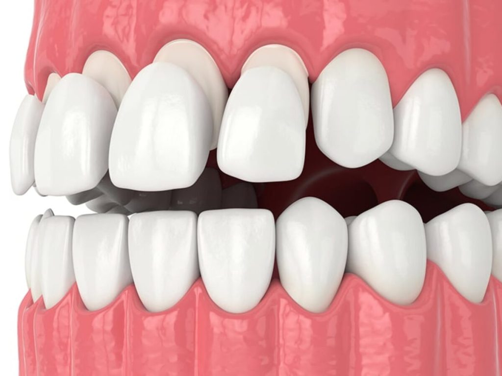 Konya kompozit diş, Kompozit diş, Kompozit dolgu Konya, Kompozit bonding Konya, Diş estetiği Konya, Estetik diş uygulamaları Konya, Diş dolgusu Konya